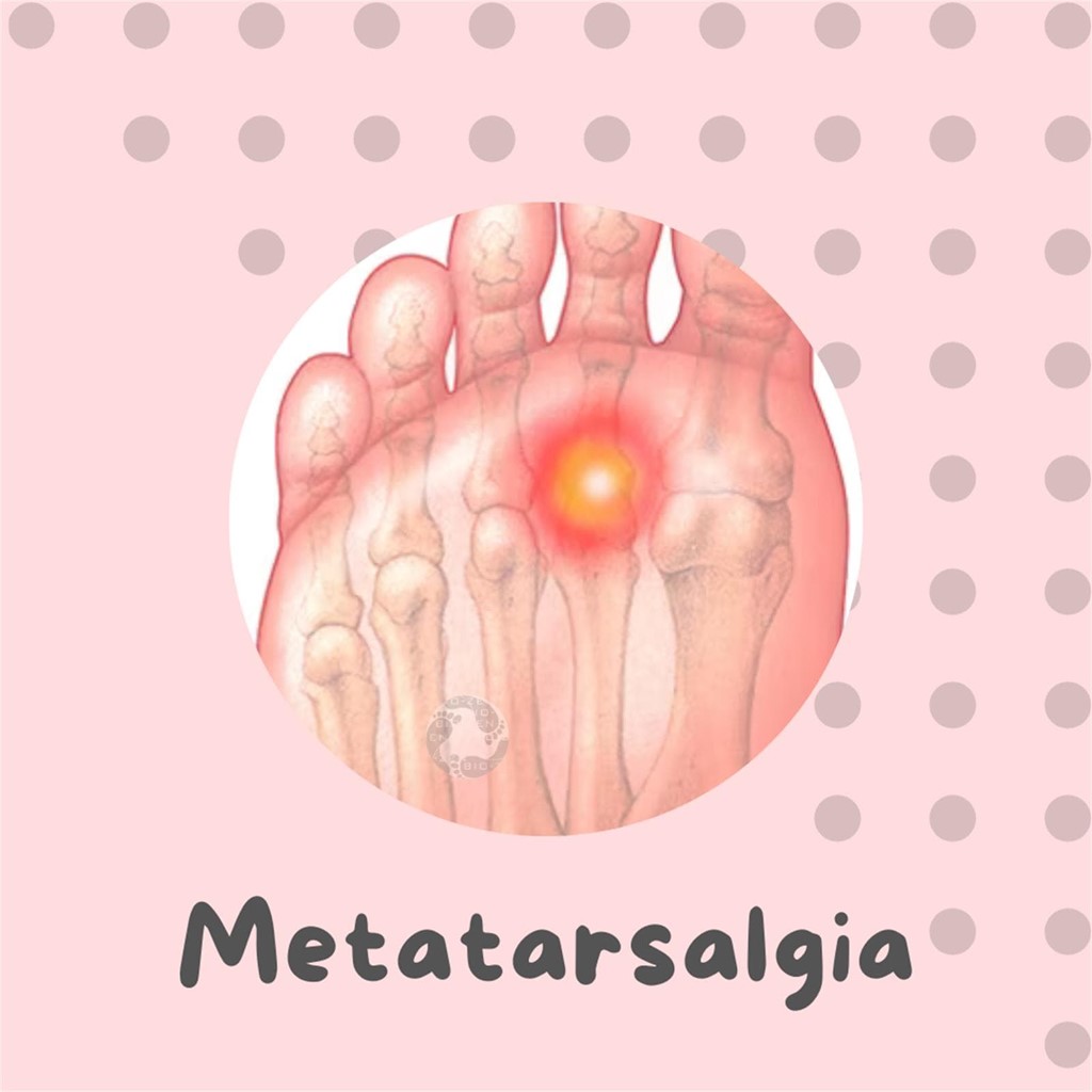 ¿Sabes lo que es la Metatarsalgia?